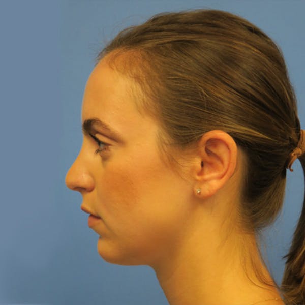Kybella Before & After Gallery - Patient 4752014 - Image 3