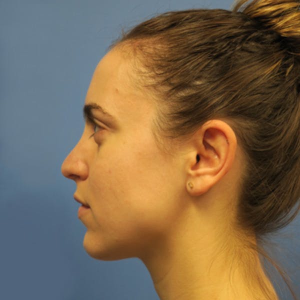 Kybella Before & After Gallery - Patient 4752014 - Image 4