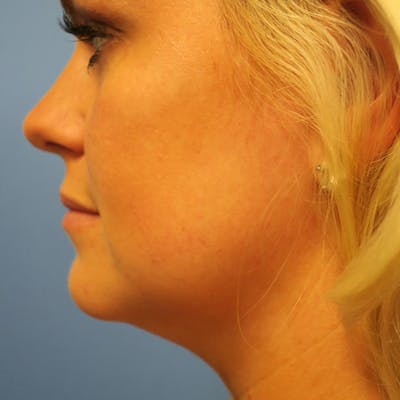 Kybella Before & After Gallery - Patient 4752015 - Image 1