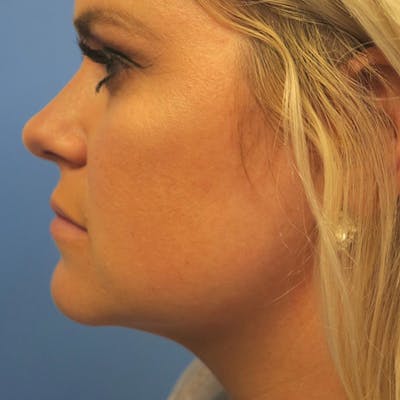 Kybella Before & After Gallery - Patient 4752015 - Image 2