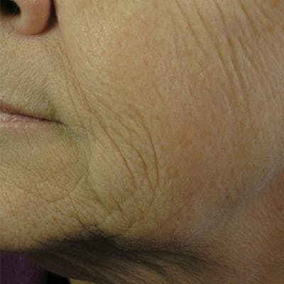 CO2 Laser Resurfacing Before & After Gallery - Patient 4752017 - Image 1