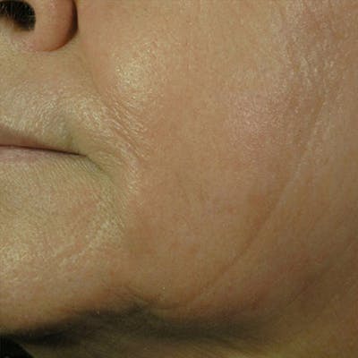 CO2 Laser Resurfacing Before & After Gallery - Patient 4752017 - Image 2