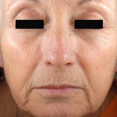 Laser Resurfacing Before & After Gallery - Patient 4752018 - Image 1