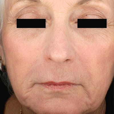 Laser Resurfacing Before & After Gallery - Patient 4752018 - Image 2