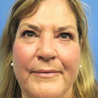 CO2 Laser Resurfacing Before & After Gallery - Patient 4752019 - Image 2