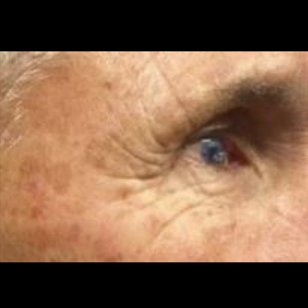 Laser Resurfacing Before & After Gallery - Patient 4752021 - Image 1