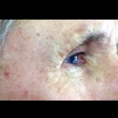 Laser Resurfacing Before & After Gallery - Patient 4752021 - Image 2