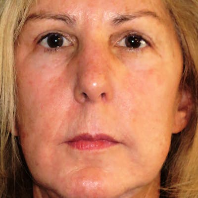 Lip Lift Before & After Gallery - Patient 4752024 - Image 1