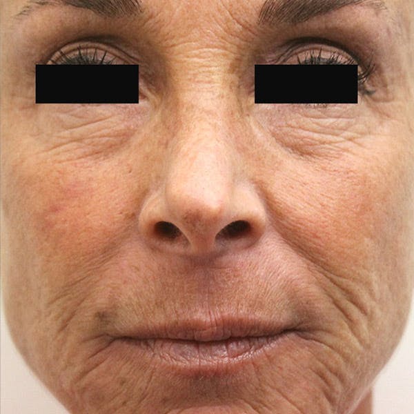Laser Resurfacing Before & After Gallery - Patient 4752025 - Image 1