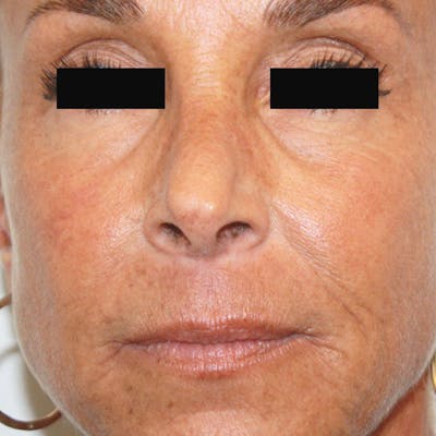 CO2 Laser Resurfacing Before & After Gallery - Patient 4752025 - Image 2
