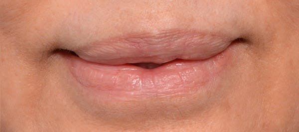 Lip Lift Before & After Gallery - Patient 4752027 - Image 1