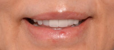 Lip Lift Before & After Gallery - Patient 4752027 - Image 2