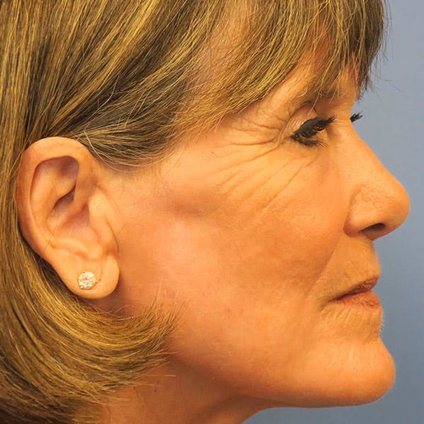 CO2 Laser Resurfacing Before & After Gallery - Patient 4752028 - Image 2