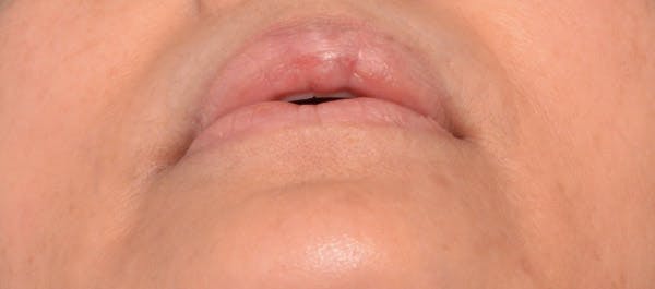 Lip Lift Before & After Gallery - Patient 4752027 - Image 3