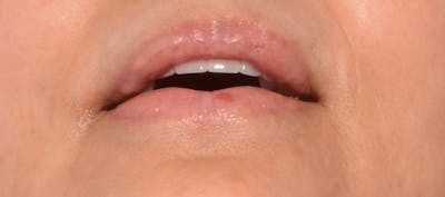 Lip Lift Before & After Gallery - Patient 4752027 - Image 4