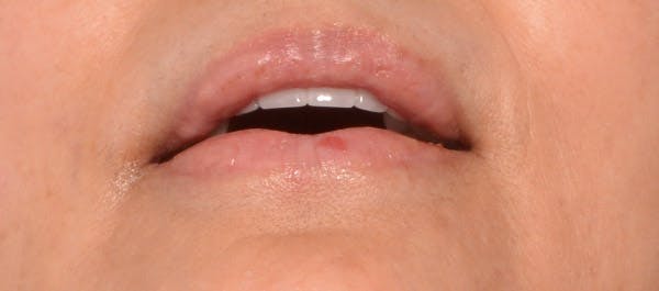 Lip Lift Before & After Gallery - Patient 4752027 - Image 4