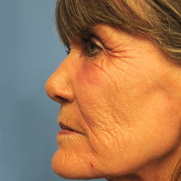 Laser Resurfacing Before & After Gallery - Patient 4752028 - Image 3