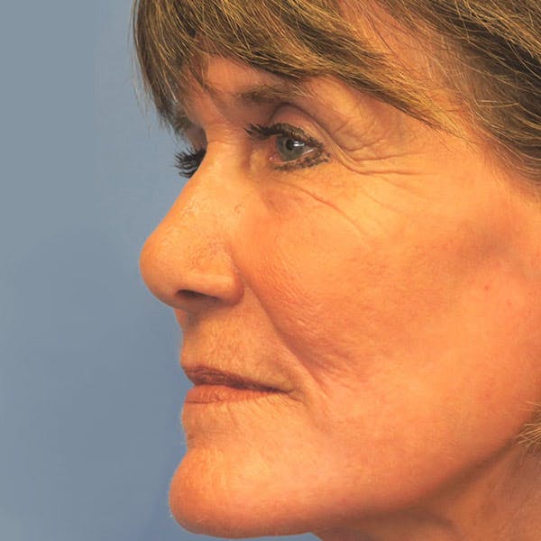CO2 Laser Resurfacing Before & After Gallery - Patient 4752028 - Image 4