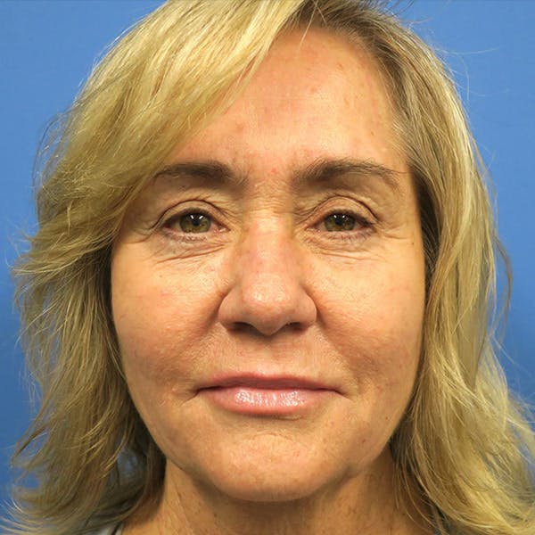 Medium Depth Chemical Peel Before & After Gallery - Patient 4752030 - Image 1