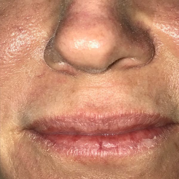 Lip Lift Before & After Gallery - Patient 4752032 - Image 1