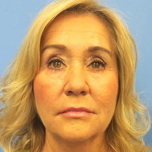 Chemical Peels