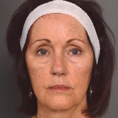 Laser Resurfacing Before & After Gallery - Patient 4752033 - Image 1
