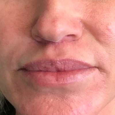 Lip Lift Before & After Gallery - Patient 4752032 - Image 2