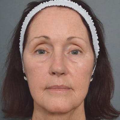 Laser Resurfacing Before & After Gallery - Patient 4752033 - Image 2