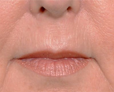 Lip Lift Before & After Gallery - Patient 4752034 - Image 1
