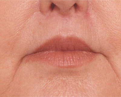 Lip Lift Before & After Gallery - Patient 4752034 - Image 2