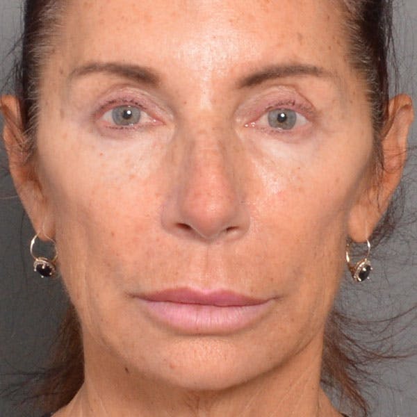 Lip Lift Before & After Gallery - Patient 4752036 - Image 1