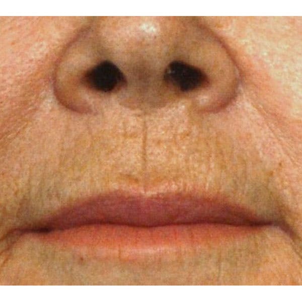 Lip Lift Before & After Gallery - Patient 4752038 - Image 1
