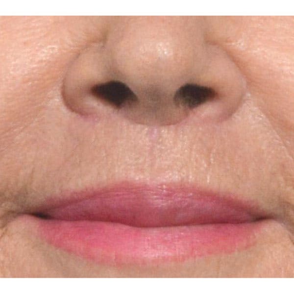 Lip Lift Before & After Gallery - Patient 4752038 - Image 2