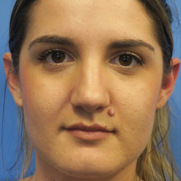 Mole Removal Before & After Gallery - Patient 4752040 - Image 1