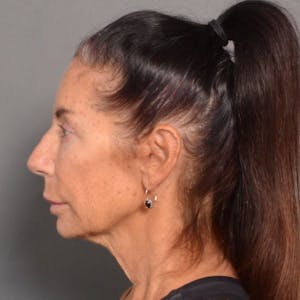 Neck Lift in Santa Barbara Before & After Photos