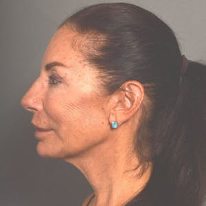 Neck Lift in Santa Barbara Before & After Photos