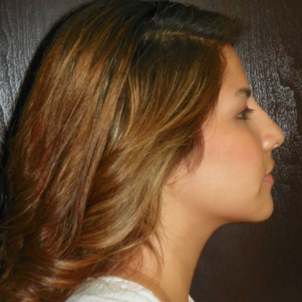 Neck Liposuction Before & After Gallery - Patient 4752044 - Image 2