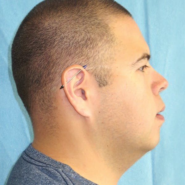 Neck Liposuction Before & After Gallery - Patient 4752045 - Image 1
