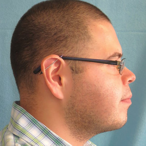 Neck Liposuction Before & After Gallery - Patient 4752045 - Image 2