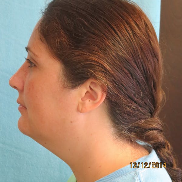 Neck Liposuction Before & After Gallery - Patient 4752046 - Image 1