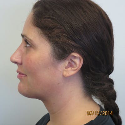 Neck Liposuction Before & After Gallery - Patient 4752046 - Image 2