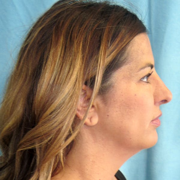 Neck Liposuction Before & After Gallery - Patient 4752047 - Image 1