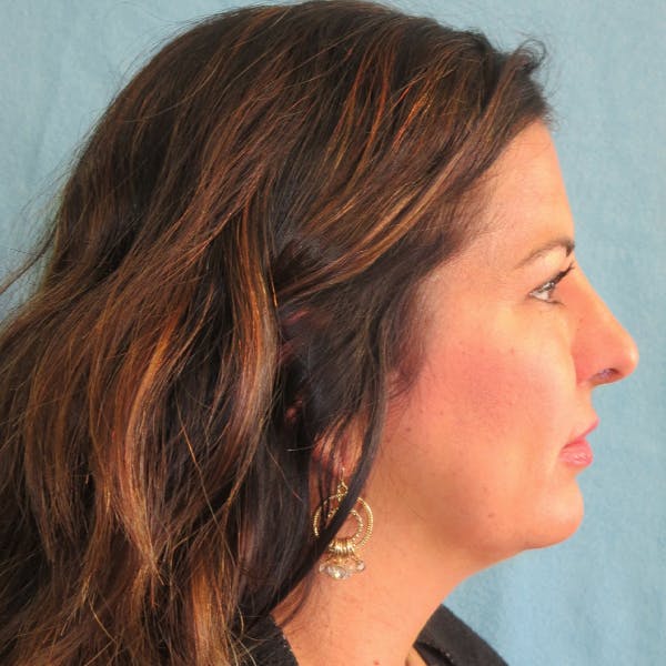 Neck Liposuction Before & After Gallery - Patient 4752047 - Image 2
