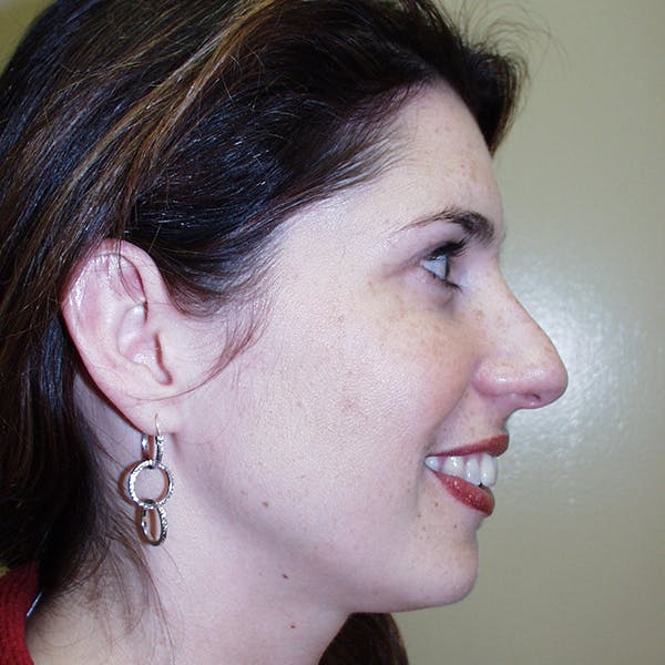 Rhinoplasty Before & After Gallery - Patient 4752048 - Image 1