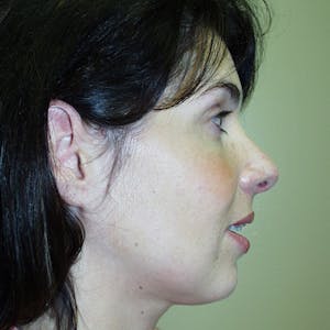 Rhinoplasty