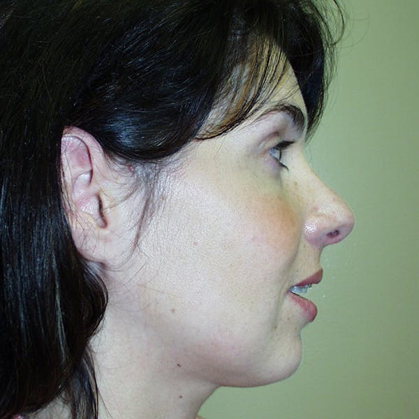 Rhinoplasty Before & After Gallery - Patient 4752048 - Image 2