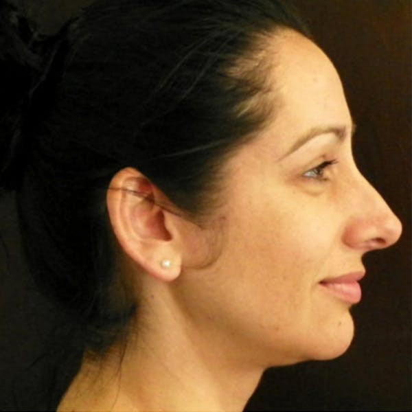 Neck Liposuction Before & After Gallery - Patient 4752049 - Image 1