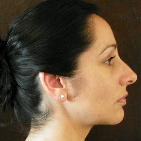 Neck Liposuction Before & After Gallery - Patient 4752049 - Image 2