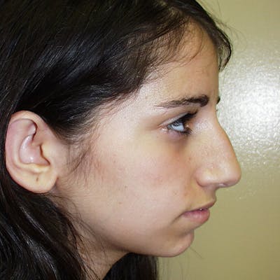 Rhinoplasty Before & After Gallery - Patient 4752050 - Image 1