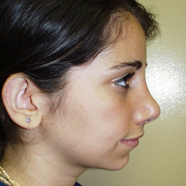Rhinoplasty Before & After Gallery - Patient 4752050 - Image 2